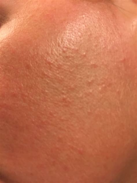 Rash Bumps On Face Pictures Photos - vrogue.co