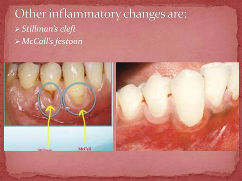 Clinical examination of gingiva | PPTX