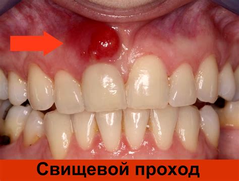Свищ в зубе | Взубе.ком