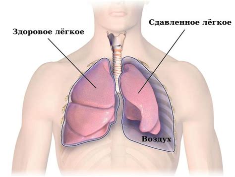 Спонтанный пневмоторакс: причины, симптомы и лечение в статье онколога ...