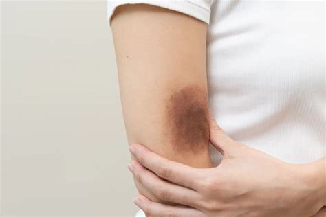 Hematoma No Corpo O Que Pode Ser - Hematoma: O Que É, Causas, Quais São Suas Fases