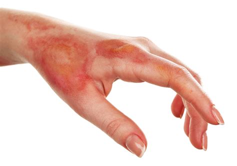 What are Burn Injuries usually caused by? | Bruning Legal