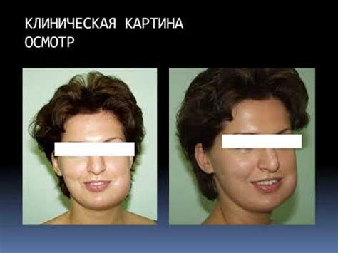 Тема 4. Периостит - YouTube