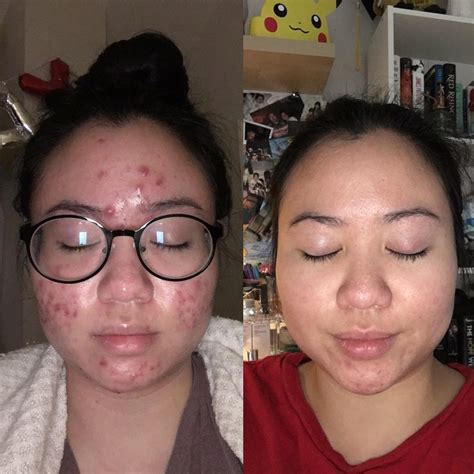 Can Salicylic Acid Cure Cystic Acne at Roger Marino blog