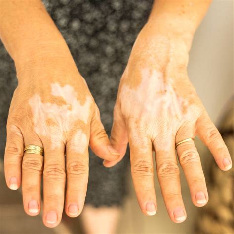 evolution  dermatology treatments  hope  chronic