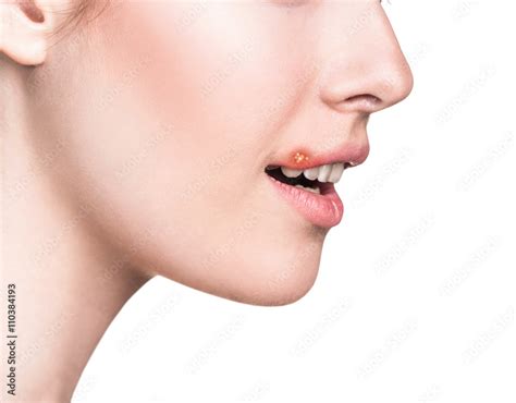 Sore on the female lips Stock Photo | Adobe Stock