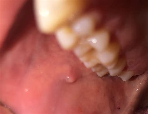 lump    cheek rdiagnoseme