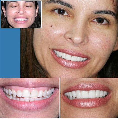 Cosmetic Dentistry Ft. Lauderdale | Porcelain Veneers | CrownsSouth ...