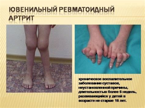 Что такое полиартрит — виды патологии, причины, признаки