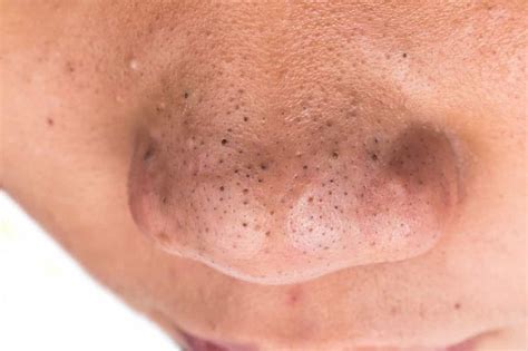 How to Get Rid of Blackheads on Nose: Fast And Natural Way