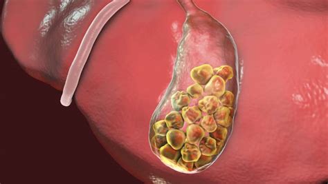 4 Things You Should Know About Gallstones- Dr. Samrat Janakr