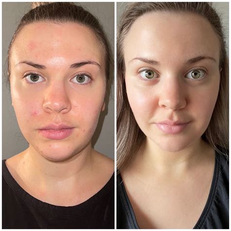 Dr derm skin results with before after pictures – Artofit