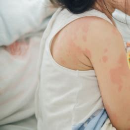 Understanding Sesame Seed Allergy | Highland Clinic