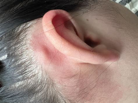 Lump Behind Ear Uk at Jean Begaye blog