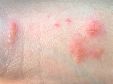 POISON IVY & OAK - Utah Valley Dermatology