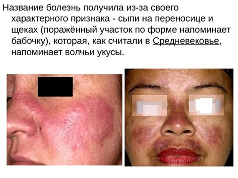 Презентация Системная Красная Волчанка