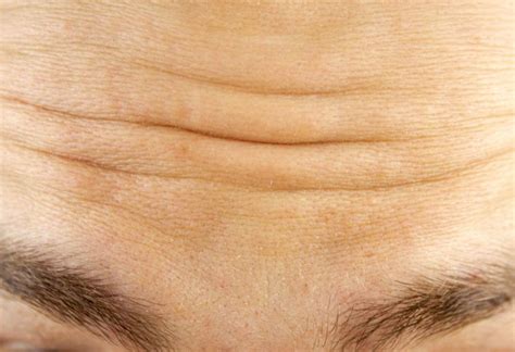 Forehead Wrinkles - Skinspire Laser&Skin Clinic