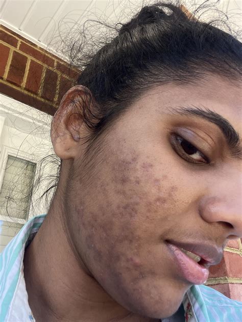 Will this hyperpigmentation ever fade or am I doomed? : r ...