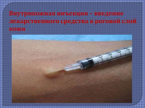 Внутрикожная инъекция - презентация онлайн