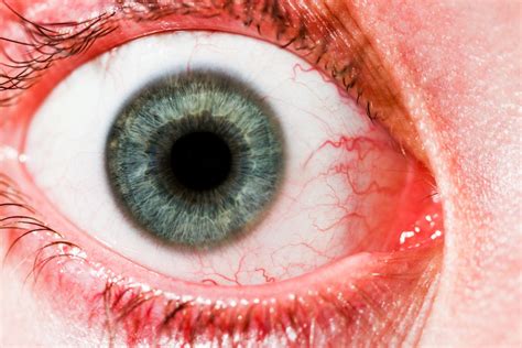 Surgeons remove parasitic worm from woman's eye - Asia Times