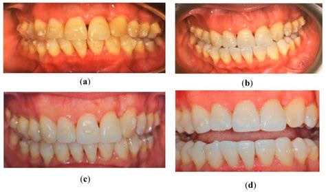 Dentistry Journal MDPI on LinkedIn: #tooth #plaque #gingival #mdpidentistry 
