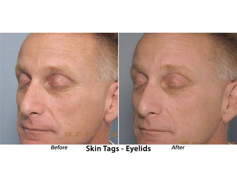 Skin Tag Removal Dermatologist - Reston Dermatology + Cosmetic Center