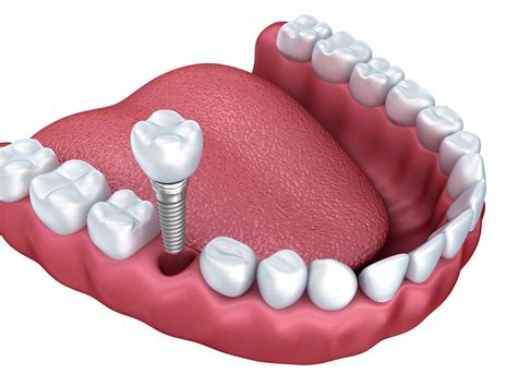 understanding dental implants jenson dental