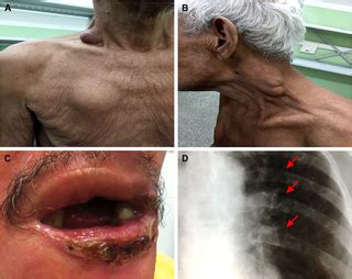 Clinical and epidemiological features of paracoccidioidomycosis due to ... 