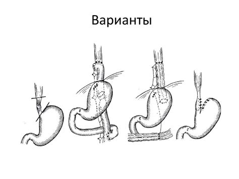 Хирургическая тактика при стенозах пищевода - презентация онлайн