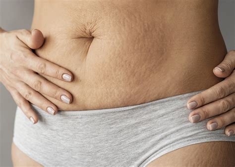 cara menghilangkan stretch mark di payudara 26