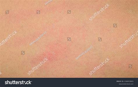 Human Skin Tan Erythema Dermatitis Stock Photo 2164419843 | Shutterstock