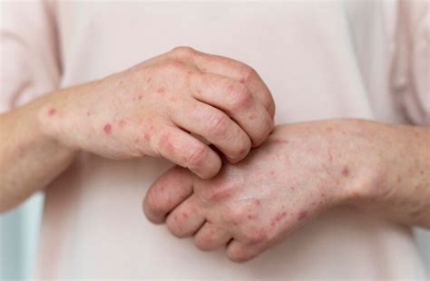 Reason Behind Itch: Eczema Causes and Symptoms