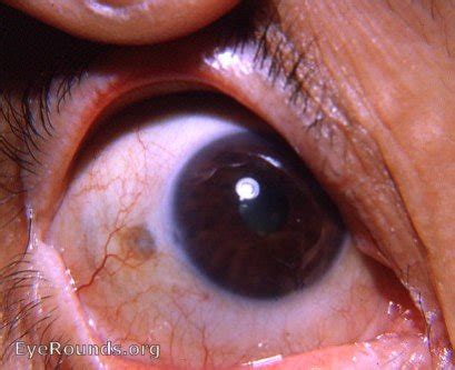 dark spots   sclera infoupdateorg