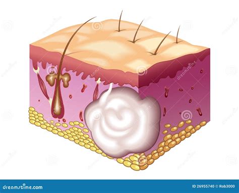 Sebaceous Cyst Stock Photo - Image: 26955740