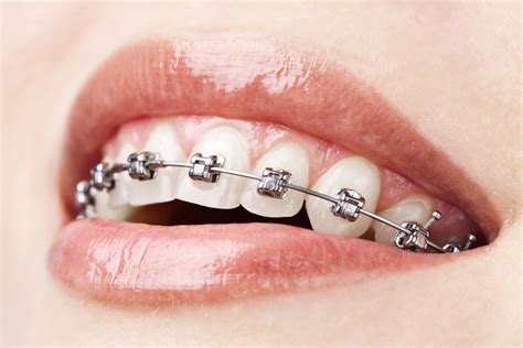 factors     braces  columbus