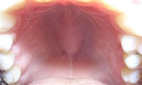 Fenda Palatina No Céu Da Boca - Variações no céu da boca influenciam a evolução das linguagens no mundo ...