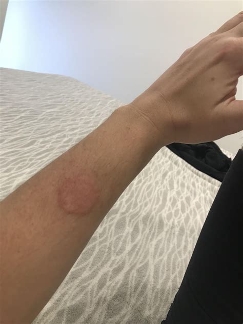 Is this nummular eczema? : r/eczema