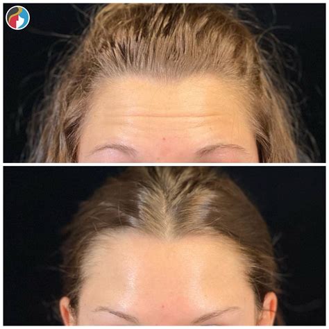 Botox Treatment | Syracuse, Albany, Rochester, New Hartford