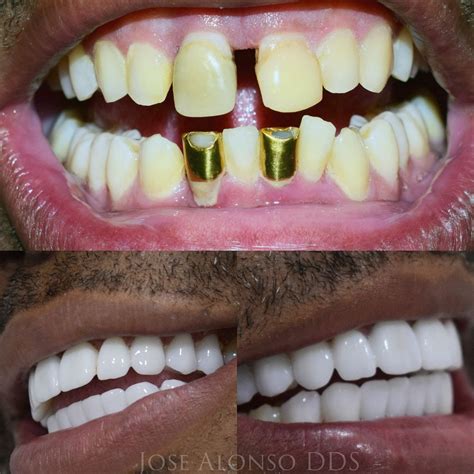 Dental Emporium Veneers Dominican Republic at Travis Day blog