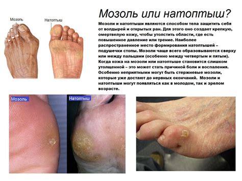 Как убрать и вывести мозоль на стопе ноги: способы лечения