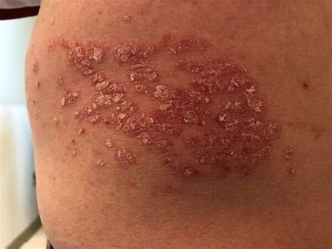 itchy scaly patches dermatology advisor