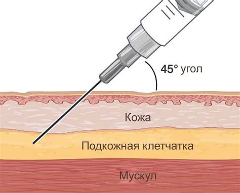 Техника выполнения подкожной инъекции под лопатку - фото презентация