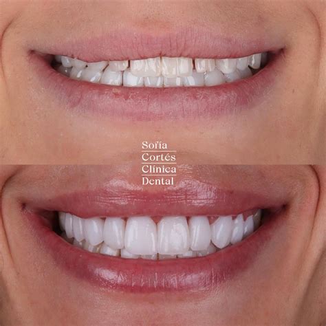 Ventaja de las carillas dentales | Sofía Cortés Clínica Dental en Valencia