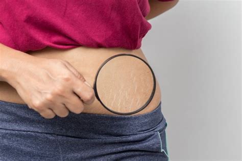 Какие секреты раскрывают растяжки на коже? | MedAboutMe