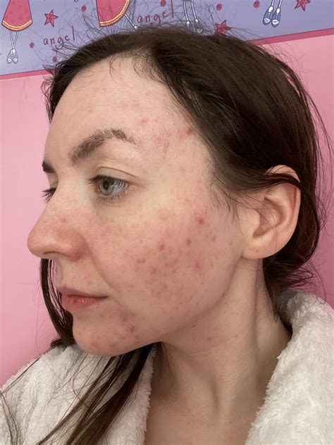 months   ab journey rasianbeauty