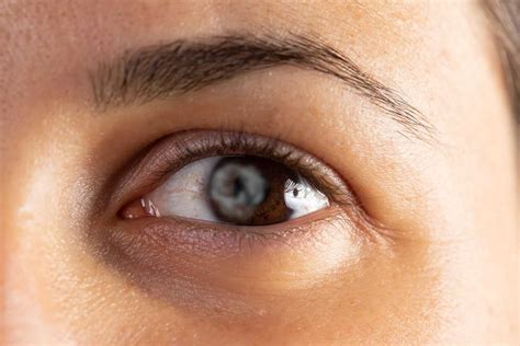 Coloboma Iris