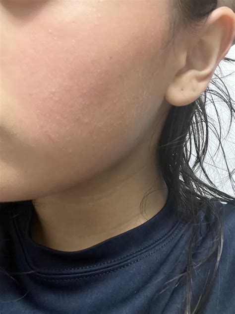 [selfie] whats causing these bumps on my jaw/cheek? : r/SkincareAddiction