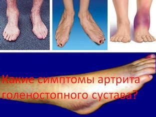 Артрит голеностопного сустава - симптомы, причины, стадии развития ...