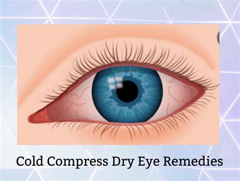 Cold Compress Dry Eye Remedies