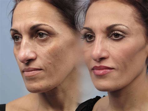skin laser center  cooper hickey blog